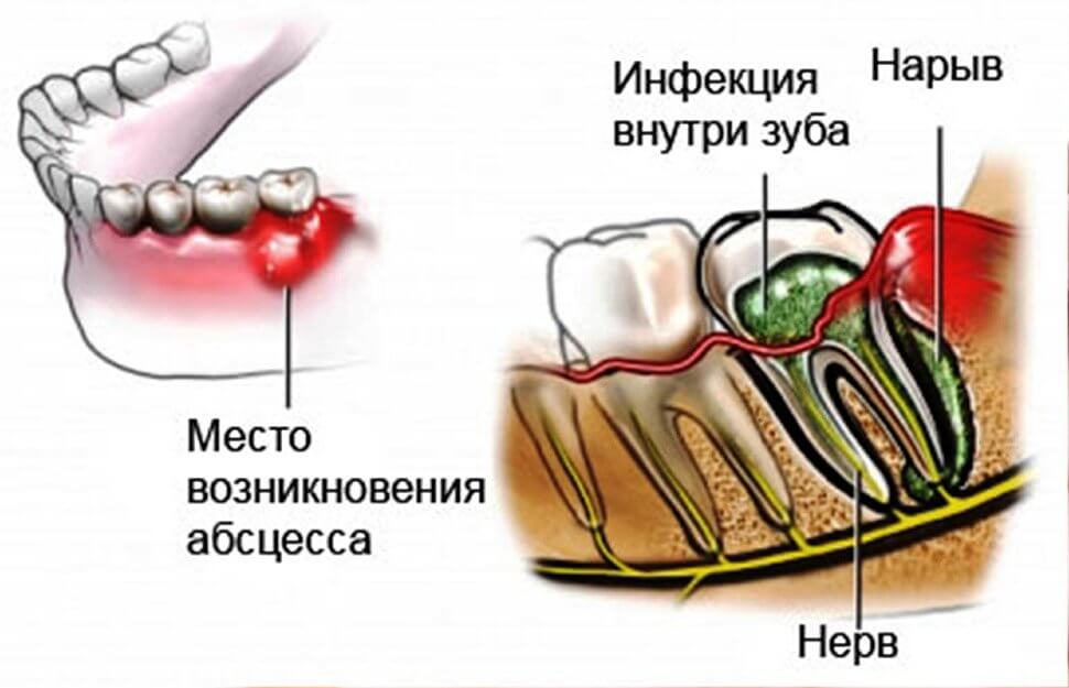 Как сделать так чтобы флюс прорвался Как сделать так чтобы флюс прорвался