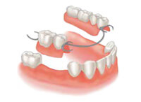 protezirovanie-zubov-osnovnoe200-146