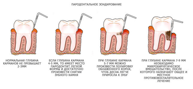 glubina-parodontalnogo-karmana