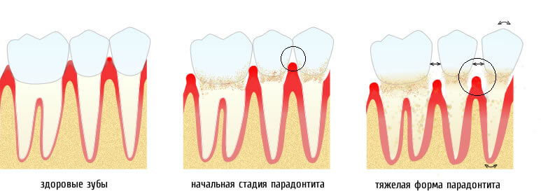 parodontit-3