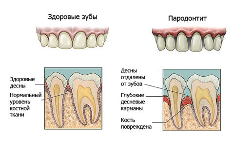 parodontit-luchshee-lechenie-v-kieve