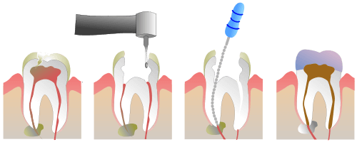 root-canal-procedure