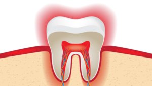 udalenie-nerva-v-zube