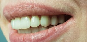 Цирконієва коронка Київ Печерськ